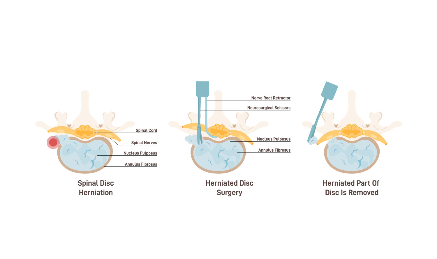 A schematic representation delineating the phases of herniated disc surgery.