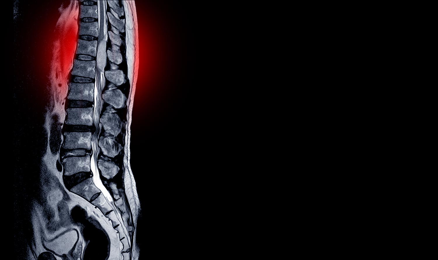 Interpretation of magnetic resonance imaging (MRI) underscores potential spinal surgical intervention.