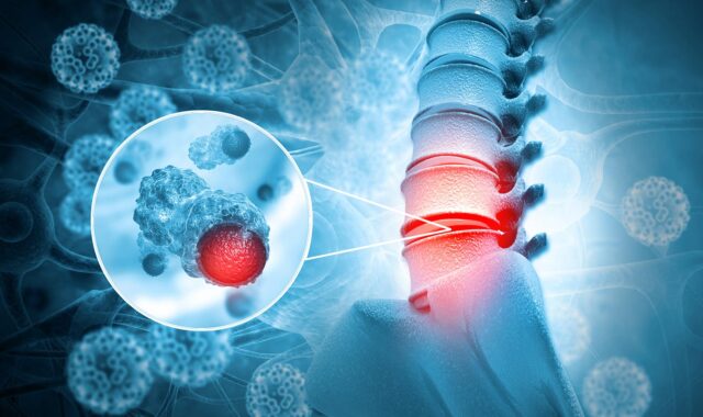 A neurographic display illustrating a vertebral column highlighting an area of interest in red, frequently examined by a practicing neurosurgeon.