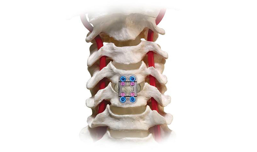 A comprehensive anatomical model of the vertebral column, inclusive of an accurately represented spinal cord, is deemed vital within a neurosurgical practice.