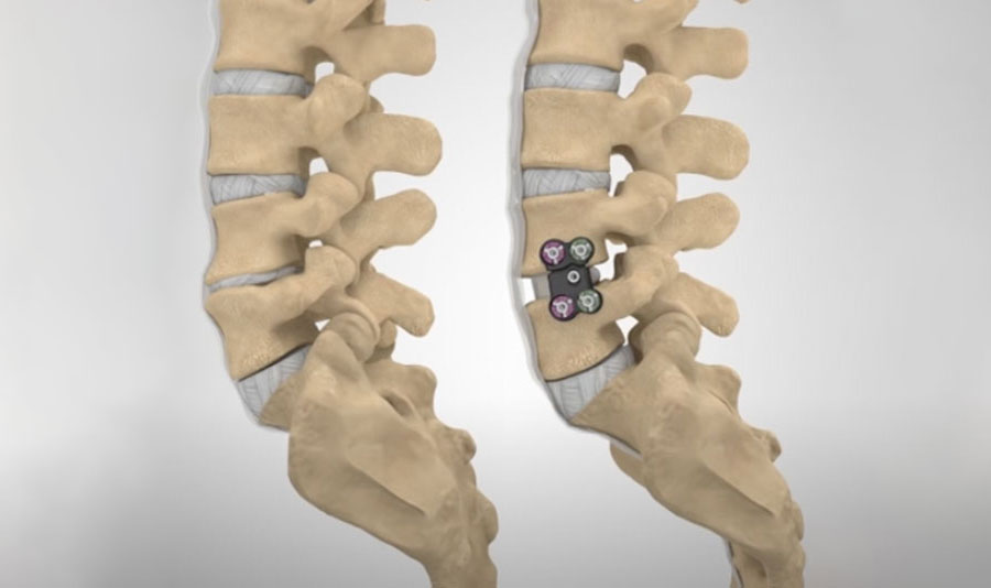 A three-dimensional graphic representation of the patient's vertebral column, intended for utilization by the neurosurgical specialist.