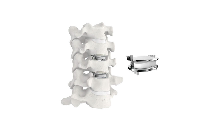 A radiographic illustration of an alabaster vertebral column, accentuated by a metallic circle accessory, optimized for a neurosurgical setting.